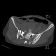Fracture of pelvis, pubic bone, subluxation of sacrum: CT - Computed tomography